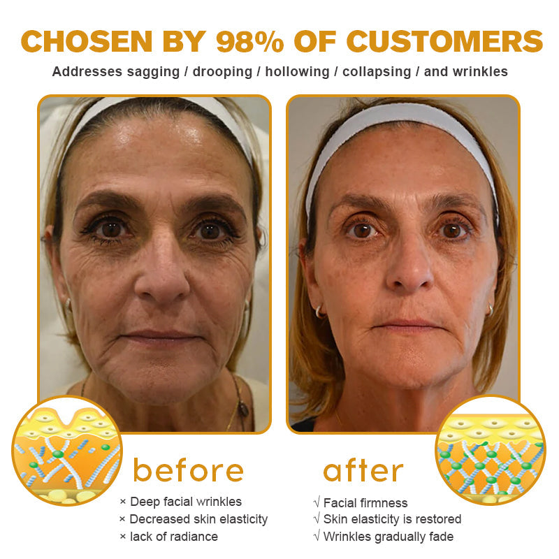 💫🍀Made and shipped from Canada✅ Furzero™ Botox Bee Venom Wrinkle Removal Cream- LAST DAY 70% OFF