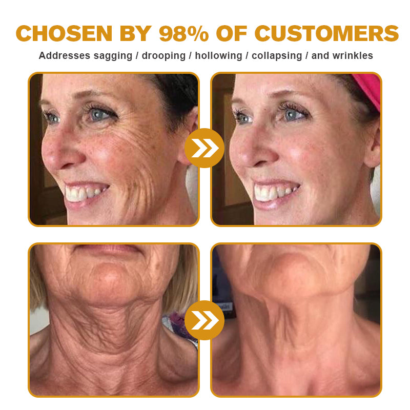 💫🍀Made and shipped from Canada✅ Furzero™ Botox Bee Venom Wrinkle Removal Cream- LAST DAY 70% OFF